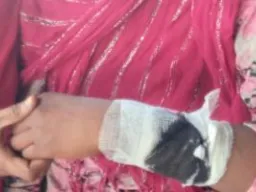 पारिवारिक विवाद में भाभी ने ननद पर किया चाकू से हमला, मुकदमा दर्ज